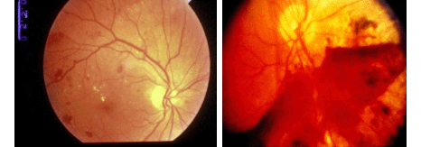 icd 9 code for cataract both eyes