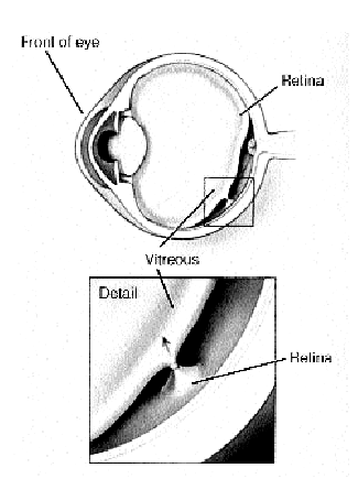 Cataract