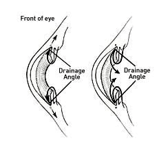 Cataract