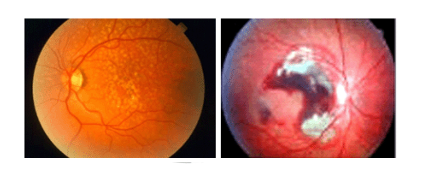 Macular-degeneration